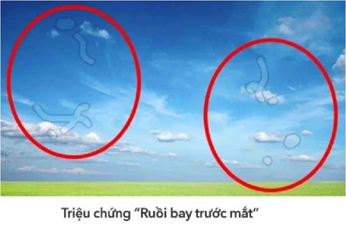 Những đốm mờ còn được gọi là "ruồi bay" (Ảnh: Internet).